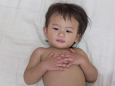 baby with rash