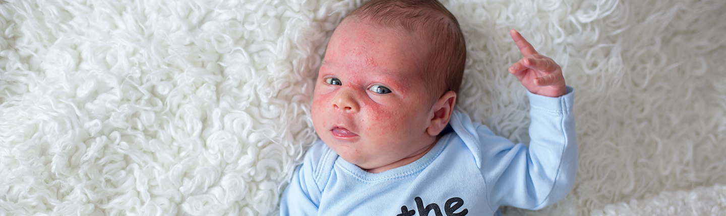 baby with skin rash
