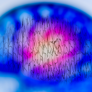 EEG with electrical activity of abnormal brain at risk of SUDEP