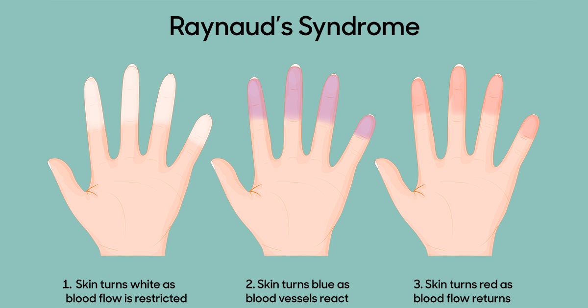 Raynaud's syndrome children - Children's National