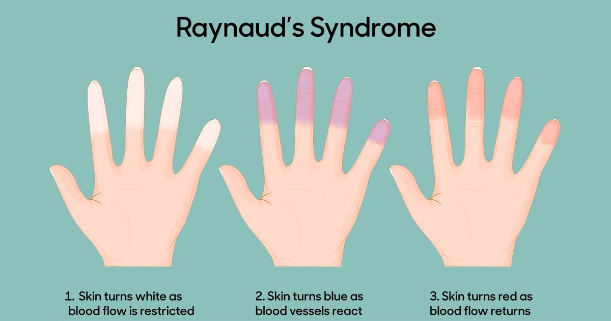 Cold Fingers, 6 Causes, Raynaud's Disease, & What To Do