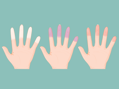 Raynaud's syndrome in children